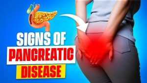 10 Early Warning Signs of Pancreatic Cancer You Need to Know